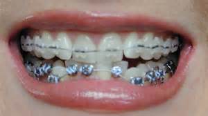 braces pain orthodontic homeopathy remedies procedures homeopathic